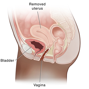 Side view cross section of female pelvis showing a hysterectomy.