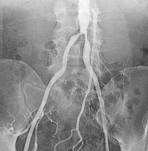 Angiograma de la aorta abdominal y las arterias ilíacas.