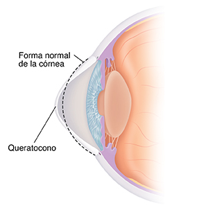 Corte transversal de un ojo con queratocono. La línea de puntos muestra la forma normal de la córnea.