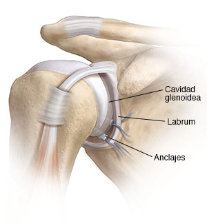 Vista frontal de la articulación del hombro donde pueden verse desgarro en la parte inferior de labrum. Se están colocando anclaje para reparar el desgarro.