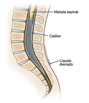 Corte transversal visto de lado de la parte inferior de la columna, donde se muestra el catéter insertado en el espacio raquídeo para drenar líquido.