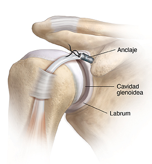 Vista frontal de la articulación del hombro donde pueden verse desgarro en la parte superior de labrum. Se están colocando anclaje para reparar el desgarro.