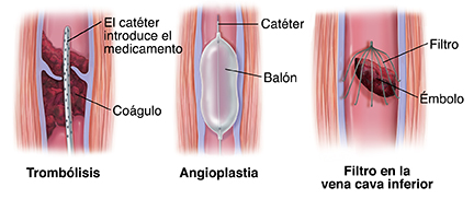 Tres maneras de tratar la trombosis venosa: catéter que envía medicamento; angioplastia con balón, filtro de émbolos.